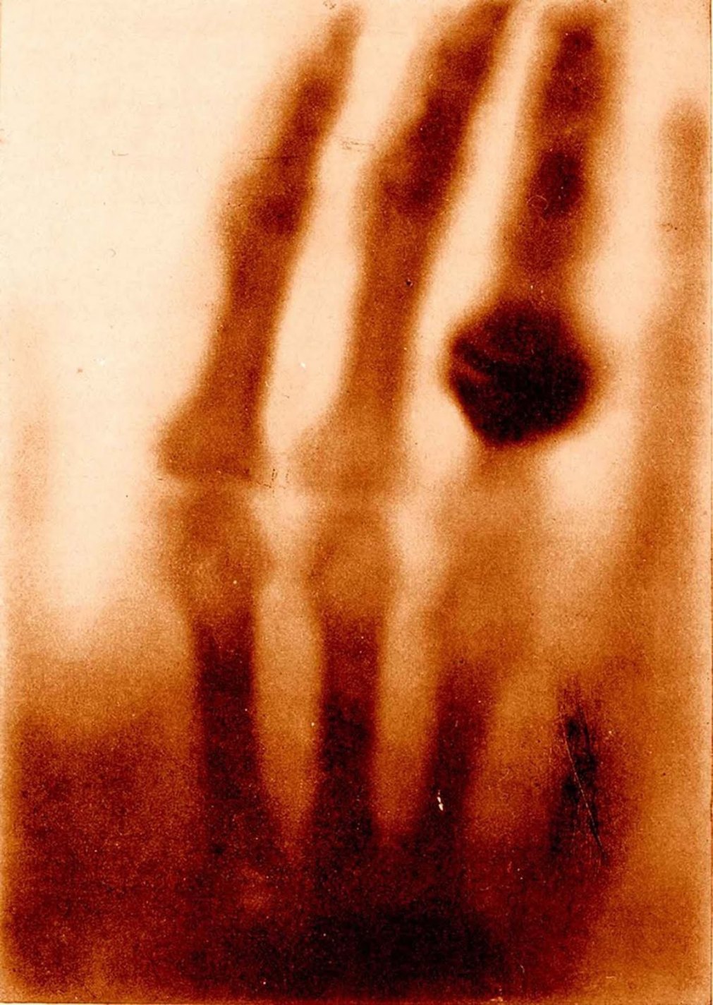 The Hand of Mrs. Wilhelm Röntgen, Wilhelm Conrad Röntgen, 1895